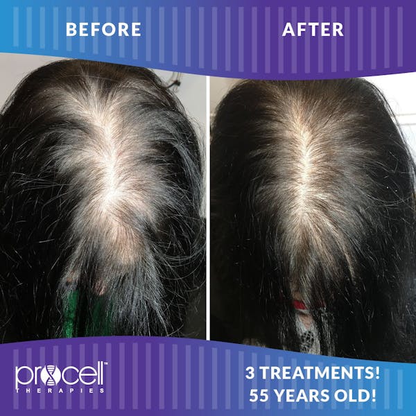Procell Hair Restoration Before & After Gallery - Patient 397218 - Image 1