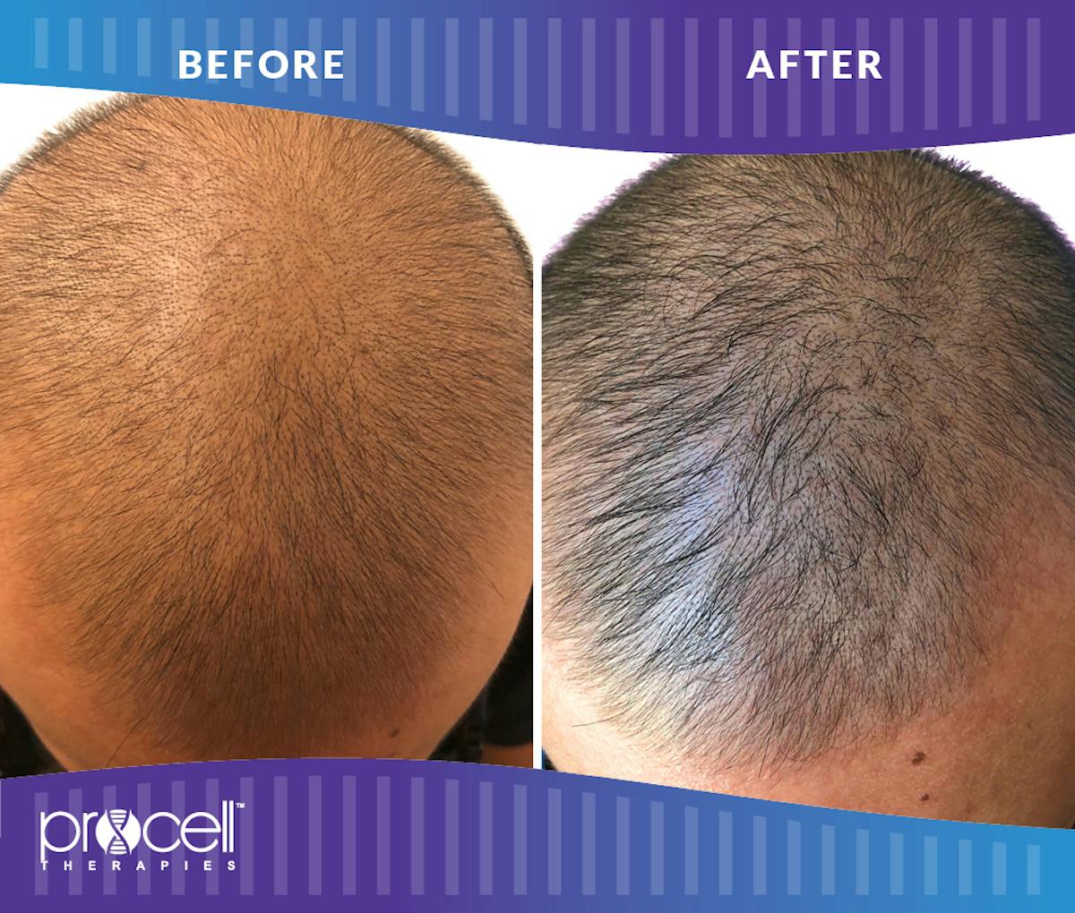 Procell Hair Restoration Before & After Gallery - Patient 364626 - Image 1