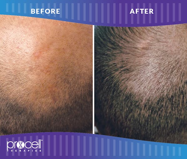 Procell Hair Restoration Before & After Gallery - Patient 479899 - Image 1
