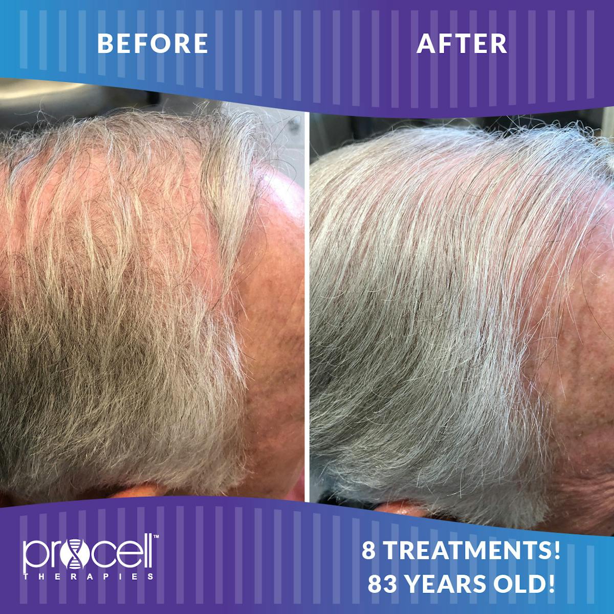 Procell Hair Restoration Before & After Gallery - Patient 219879 - Image 1