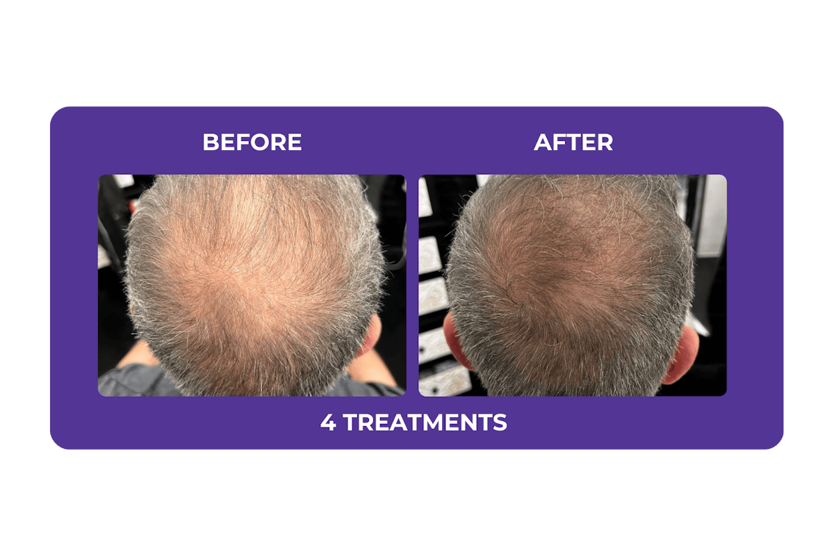 Procell Hair Restoration Before & After Gallery - Patient 269342 - Image 1