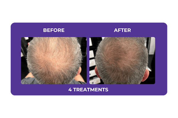 Procell Hair Restoration Before & After Gallery - Patient 269342 - Image 1