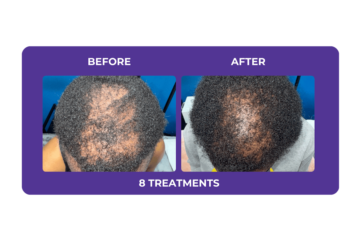 Procell Hair Restoration Before & After Gallery - Patient 357807 - Image 1