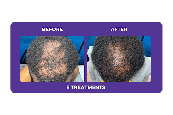 Procell Hair Restoration Before & After Gallery - Patient 357807 - Image 1