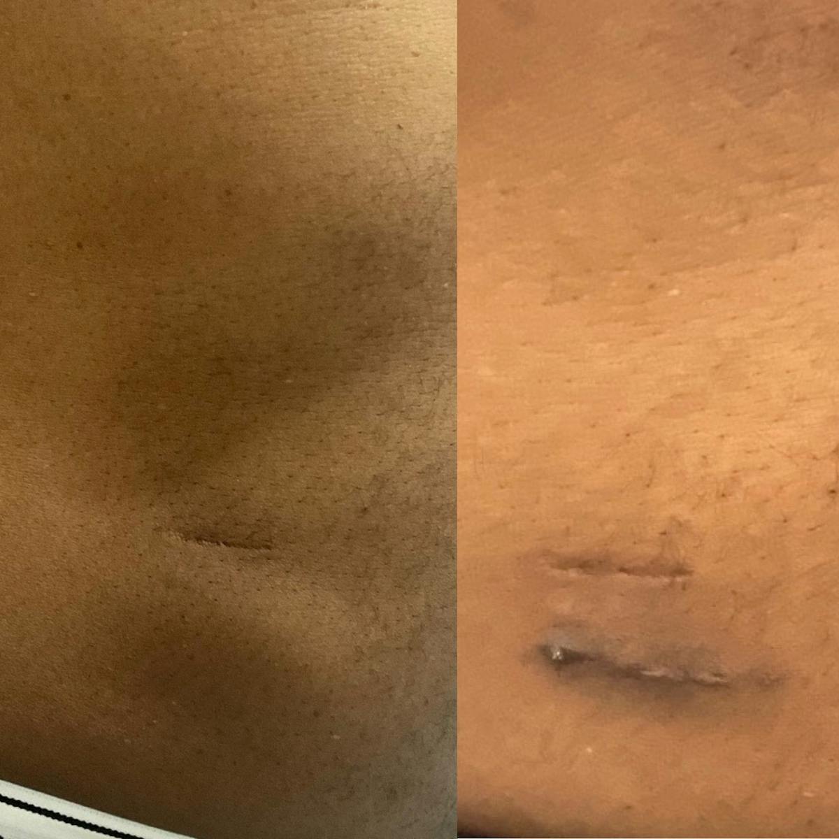 Lipoma Before & After Gallery - Patient 143808 - Image 1