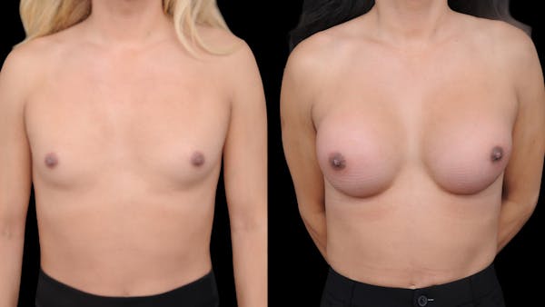 Breast Augmentation Before & After Gallery - Patient 371579 - Image 1
