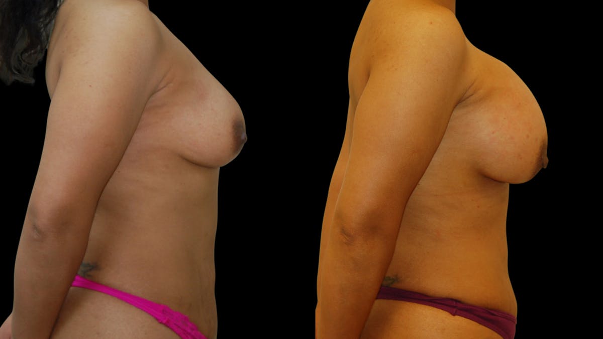 Breast Augmentation Before & After Gallery - Patient 248378 - Image 1