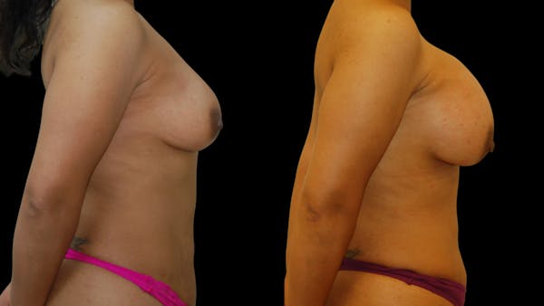 Breast Augmentation Before & After Gallery - Patient 248378 - Image 1