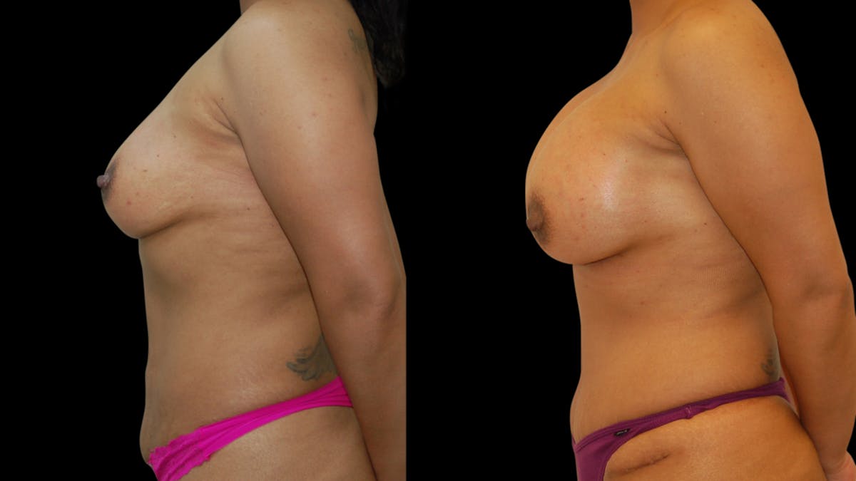 Breast Augmentation Before & After Gallery - Patient 248378 - Image 2