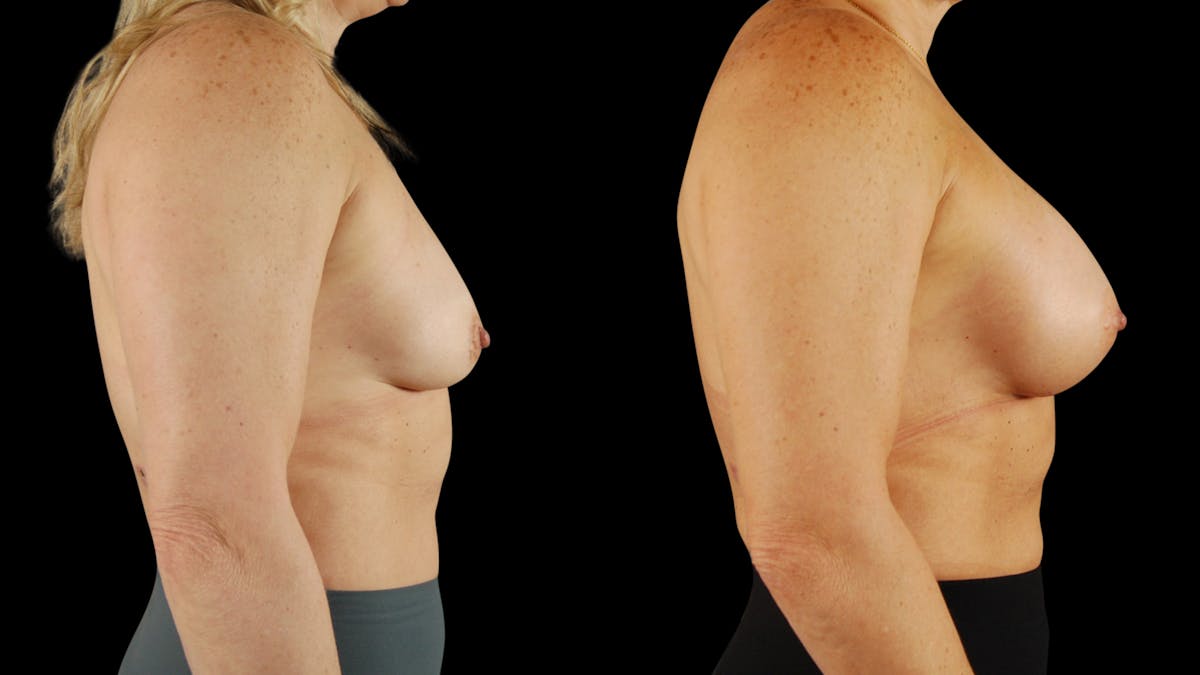 Breast Augmentation Before & After Gallery - Patient 237675 - Image 2