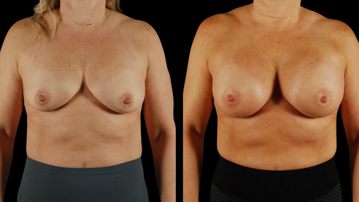 Breast Augmentation Before & After Gallery - Patient 237675 - Image 1