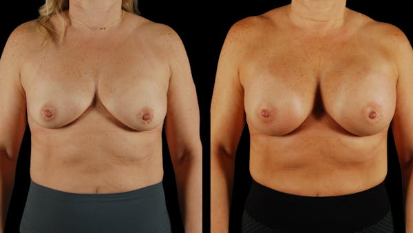 Breast Augmentation Before & After Gallery - Patient 237675 - Image 1