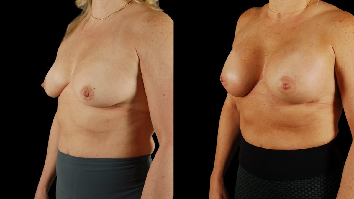 Breast Augmentation Before & After Gallery - Patient 237675 - Image 3