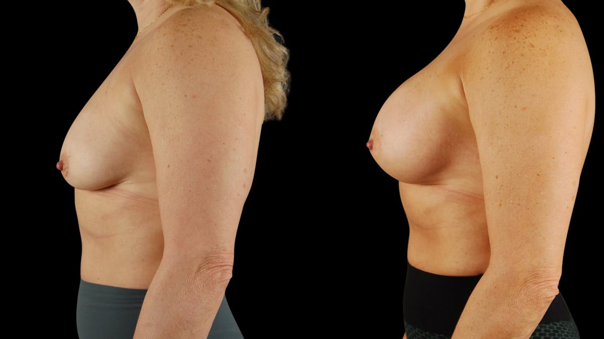 Breast Augmentation Before & After Gallery - Patient 237675 - Image 4