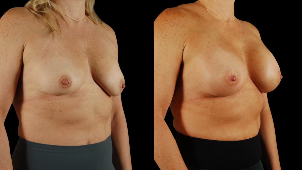 Breast Augmentation Before & After Gallery - Patient 237675 - Image 5