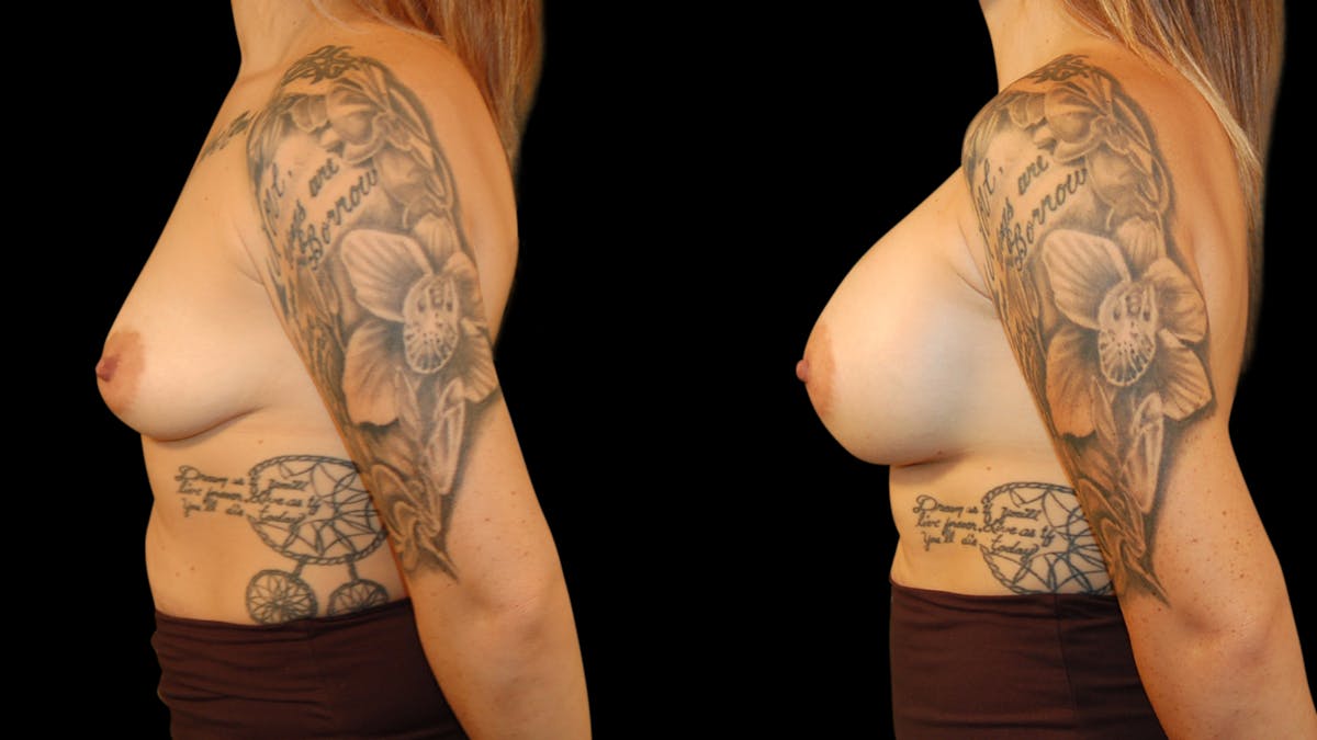 Breast Augmentation Before & After Gallery - Patient 217149 - Image 3