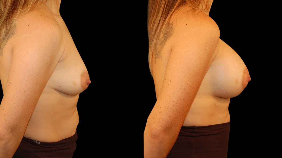 Breast Augmentation Before & After Gallery - Patient 217149 - Image 5