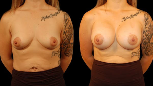 Breast Augmentation Before & After Gallery - Patient 217149 - Image 1