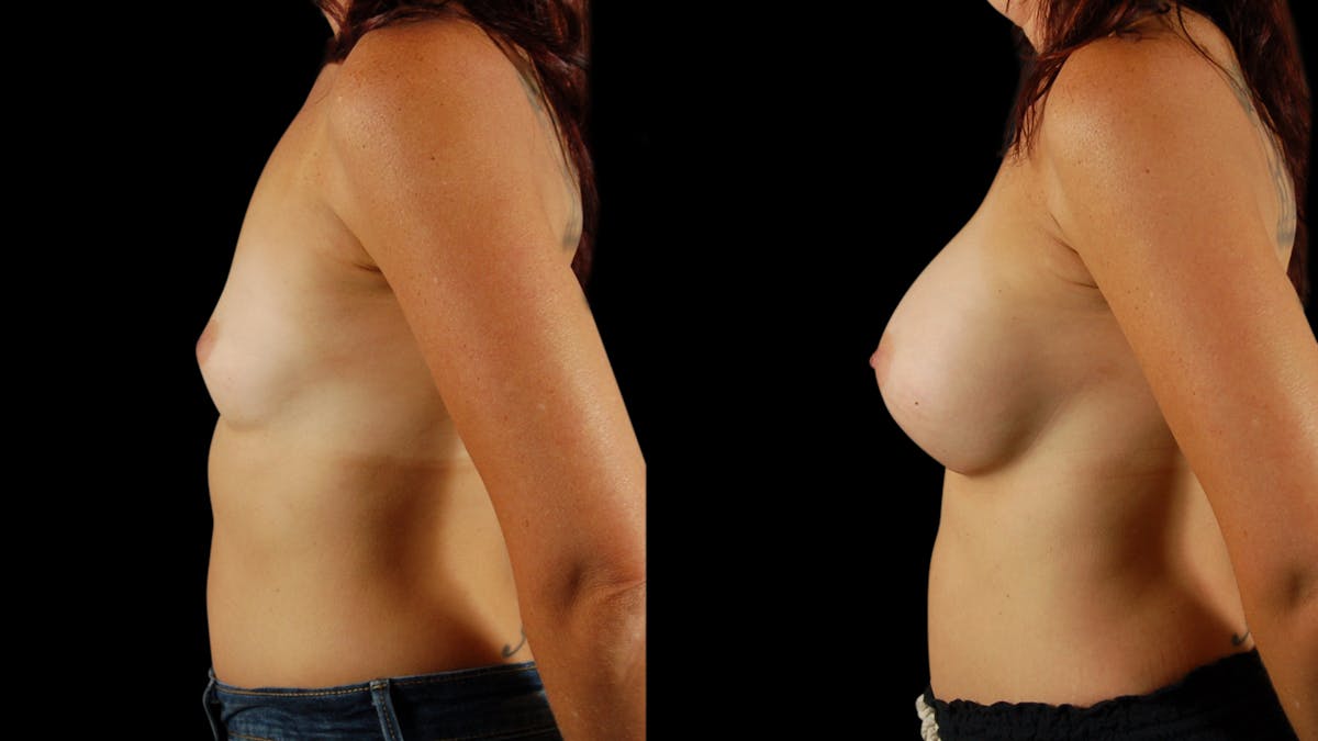 Breast Augmentation Before & After Gallery - Patient 274598 - Image 2