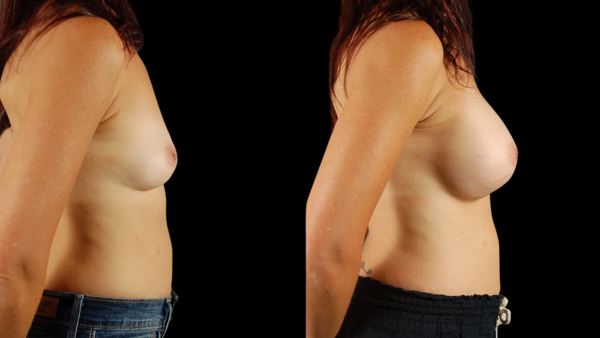 Breast Augmentation Before & After Gallery - Patient 274598 - Image 3