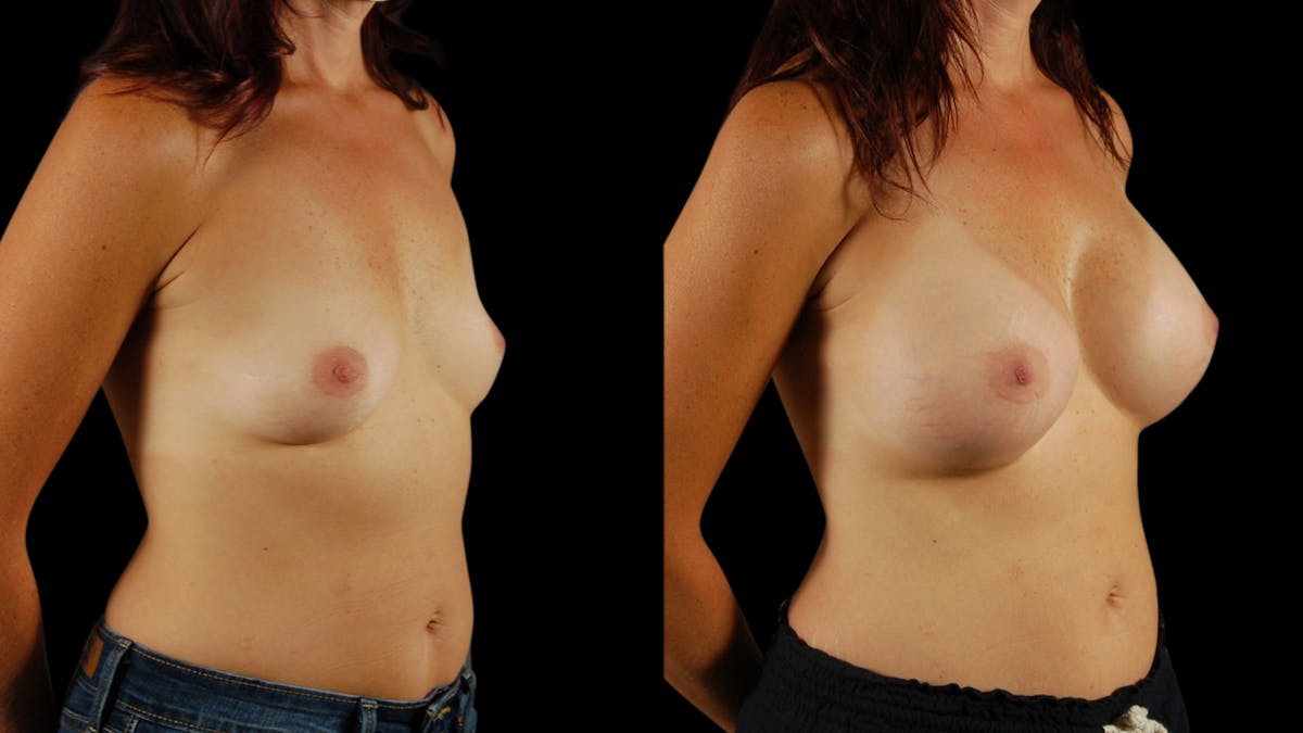 Breast Augmentation Before & After Gallery - Patient 274598 - Image 5