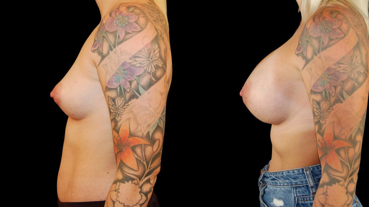 Breast Augmentation Before & After Gallery - Patient 289611 - Image 5