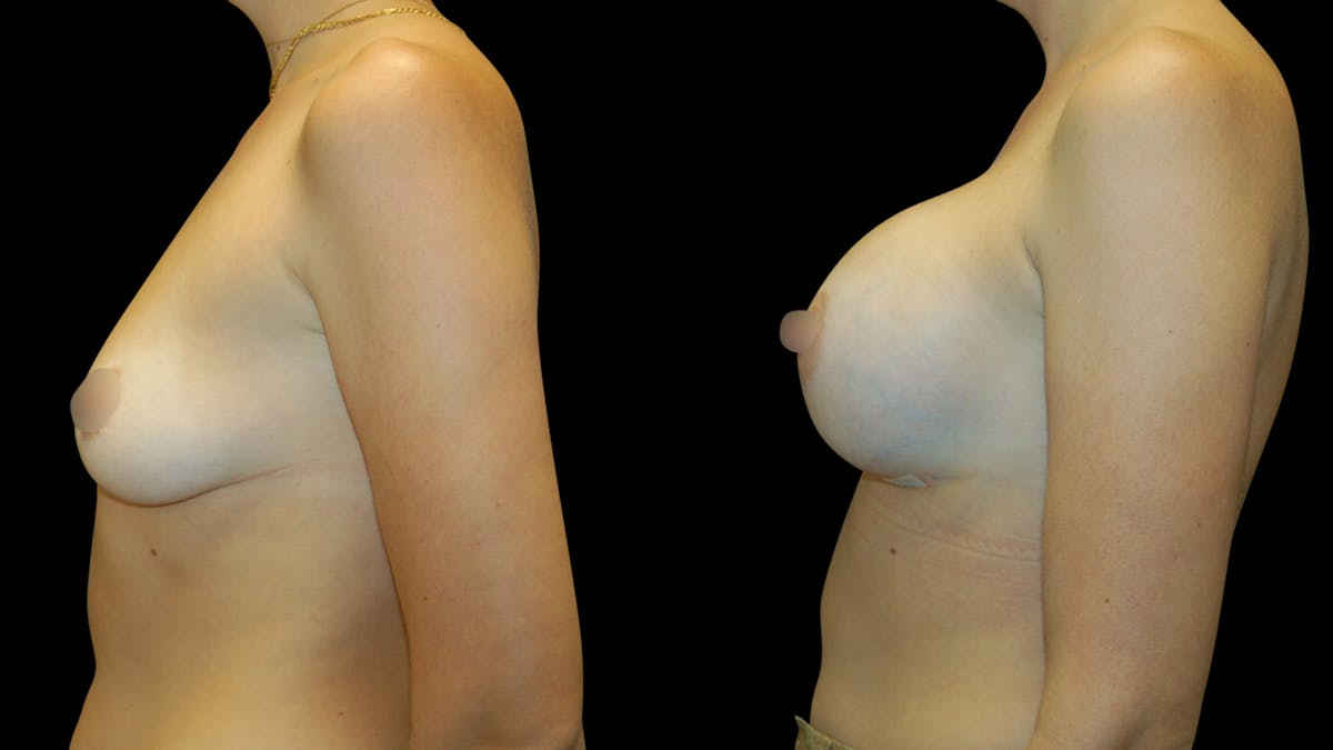Breast Augmentation Before & After Gallery - Patient 160542 - Image 3