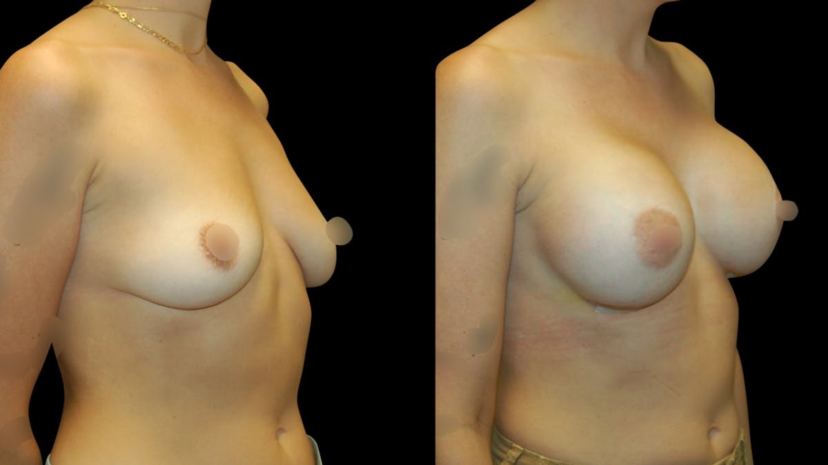Breast Augmentation Before & After Gallery - Patient 160542 - Image 4
