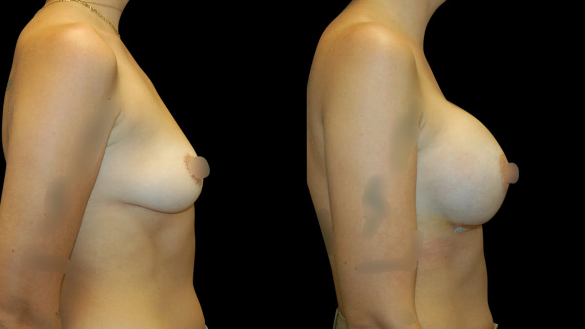 Breast Augmentation Before & After Gallery - Patient 160542 - Image 5