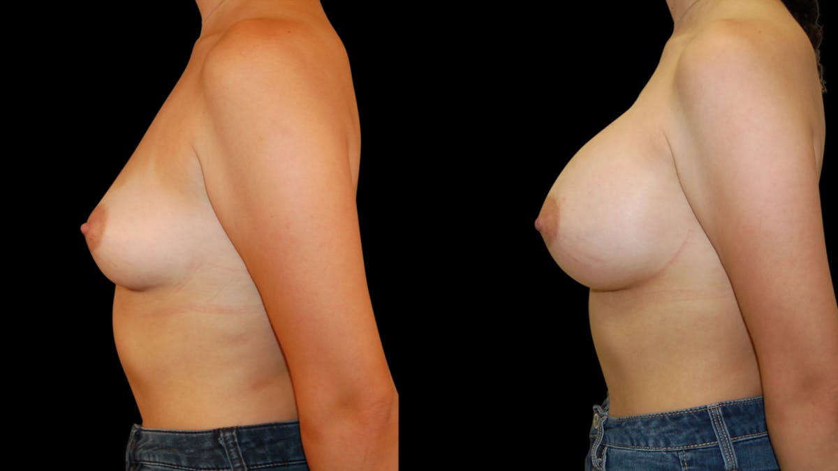 Breast Augmentation Before & After Gallery - Patient 383221 - Image 2