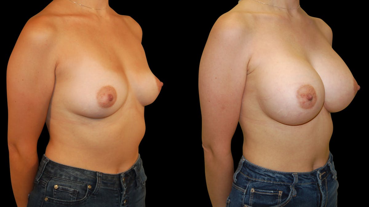 Breast Augmentation Before & After Gallery - Patient 383221 - Image 4