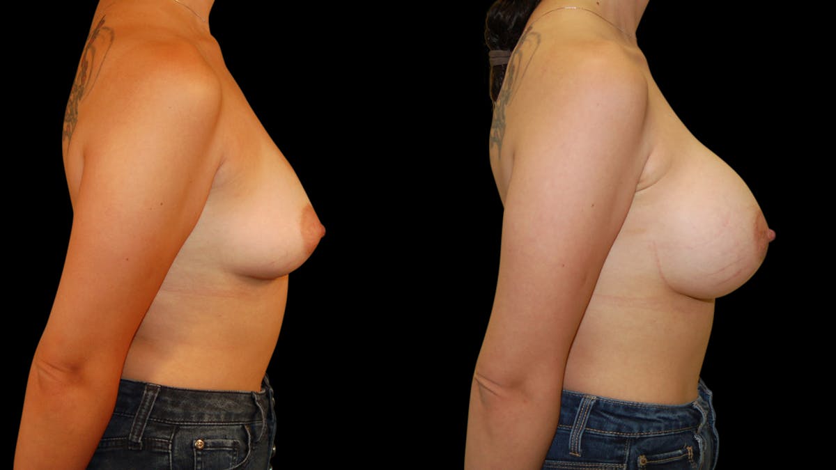 Breast Augmentation Before & After Gallery - Patient 383221 - Image 5