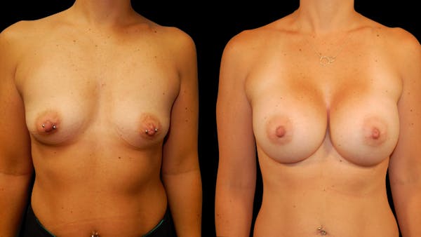 Breast Augmentation Before & After Gallery - Patient 425262 - Image 1