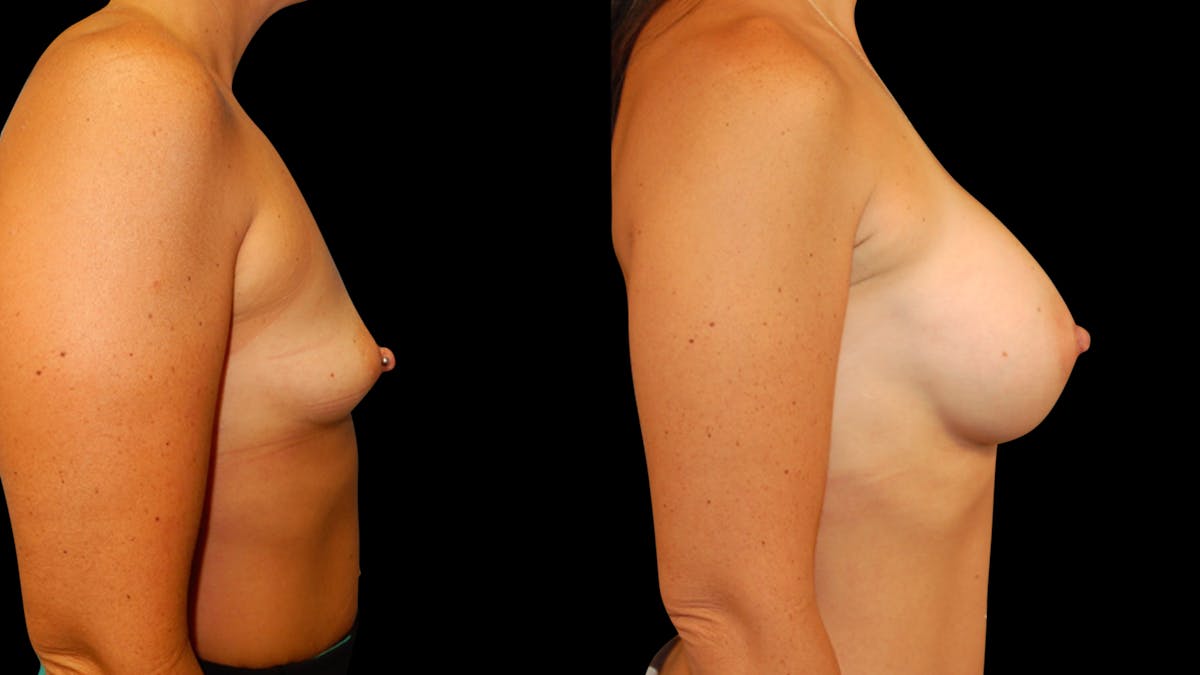 Breast Augmentation Before & After Gallery - Patient 425262 - Image 3