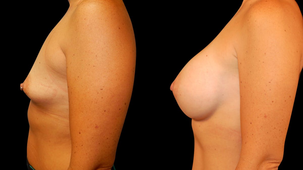Breast Augmentation Before & After Gallery - Patient 425262 - Image 5
