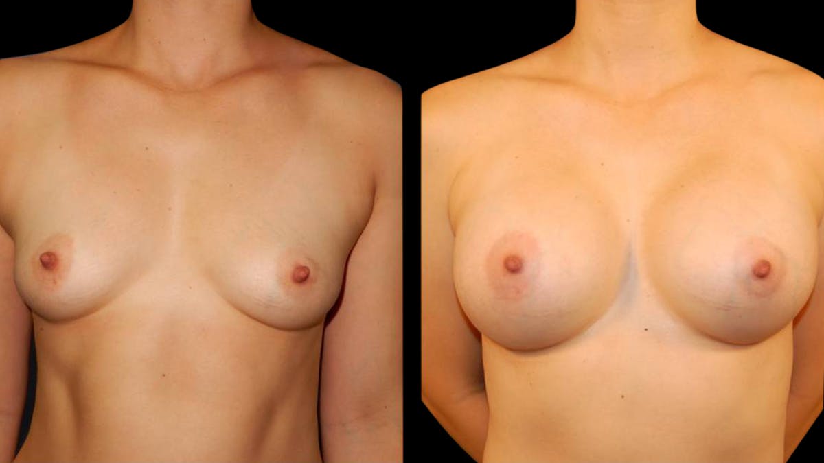 Breast Augmentation Before & After Gallery - Patient 196715 - Image 1