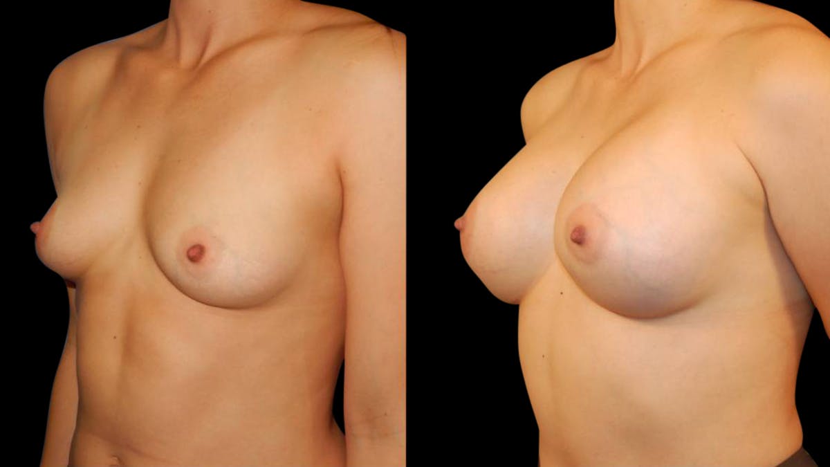 Breast Augmentation Before & After Gallery - Patient 196715 - Image 2
