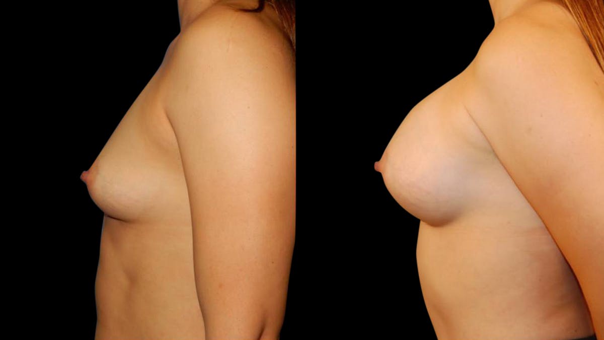 Breast Augmentation Before & After Gallery - Patient 196715 - Image 3