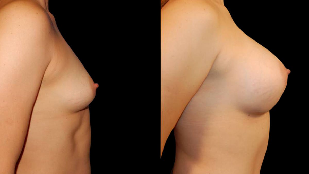 Breast Augmentation Before & After Gallery - Patient 196715 - Image 5