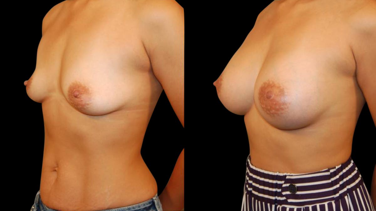 Breast Augmentation Before & After Gallery - Patient 280430 - Image 2