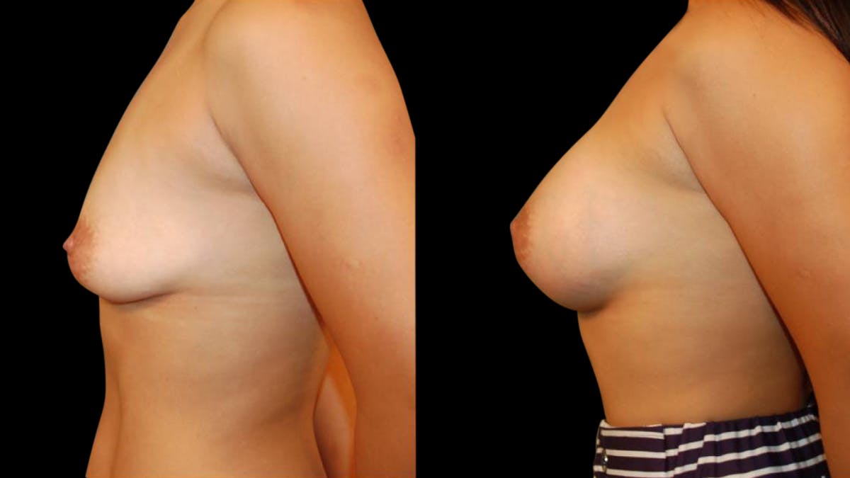 Breast Augmentation Before & After Gallery - Patient 280430 - Image 3