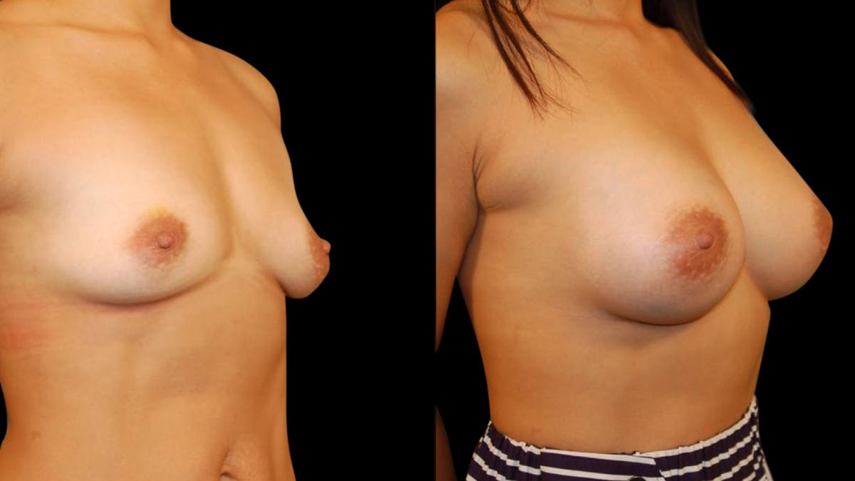 Breast Augmentation Before & After Gallery - Patient 280430 - Image 4
