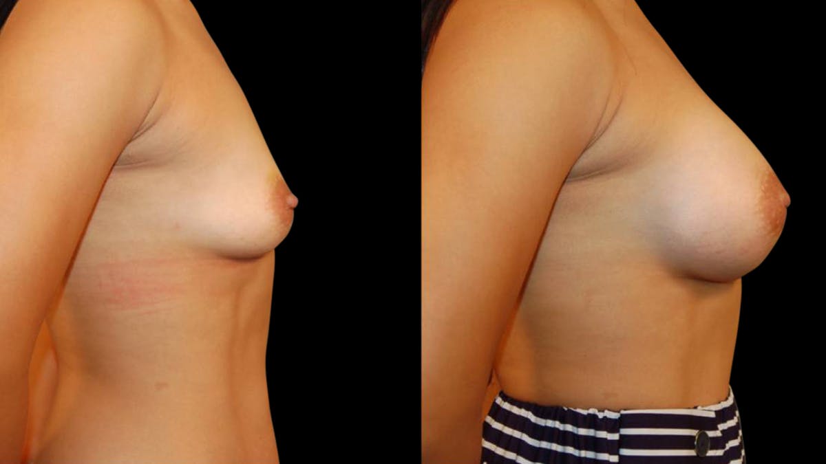 Breast Augmentation Before & After Gallery - Patient 280430 - Image 5