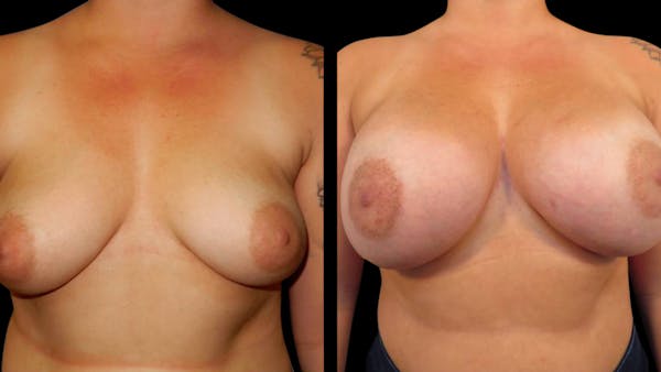 Breast Augmentation Before & After Gallery - Patient 351916 - Image 1