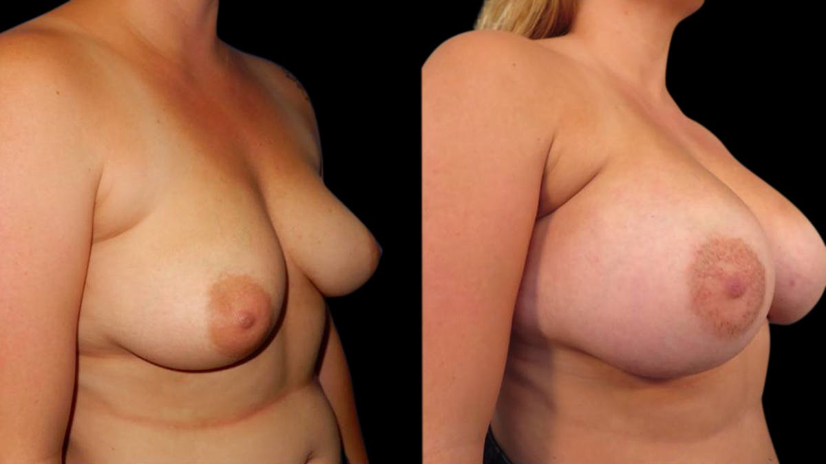 Breast Augmentation Before & After Gallery - Patient 351916 - Image 2