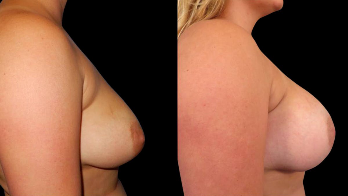 Breast Augmentation Before & After Gallery - Patient 351916 - Image 3