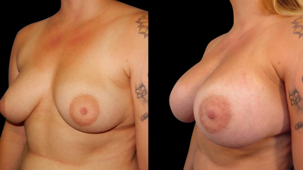 Breast Augmentation Before & After Gallery - Patient 351916 - Image 4