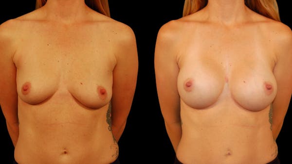 Breast Augmentation Before & After Gallery - Patient 259056 - Image 1