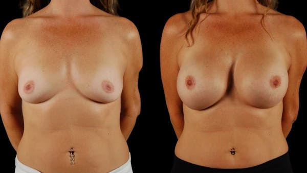 Breast Augmentation Before & After Gallery - Patient 269484 - Image 1