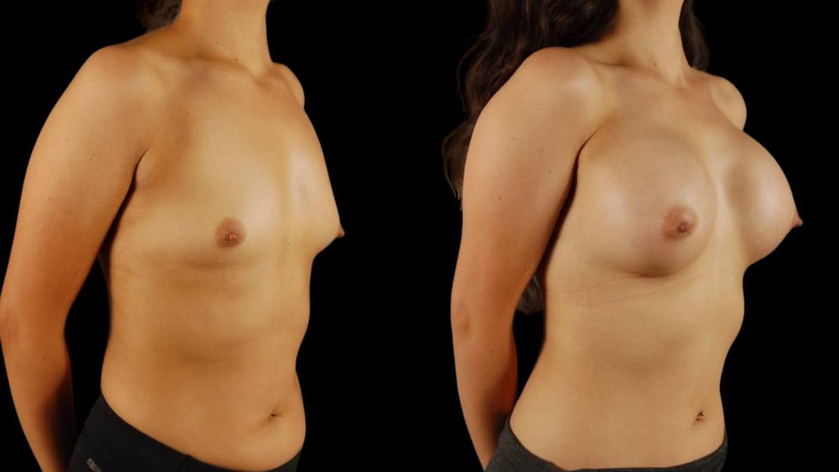 Breast Augmentation Before & After Gallery - Patient 269484 - Image 2